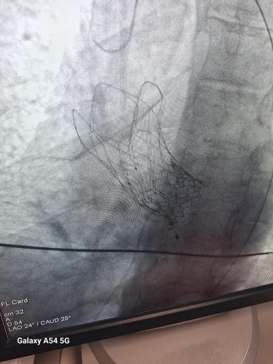 TAVR/TAVI in Replacing Heart