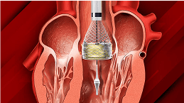 TAVI Doctor in Delhi