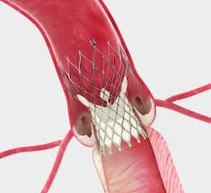 TAVI Doctor in Delhi