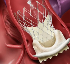 TAVI Doctor in Chandigarh