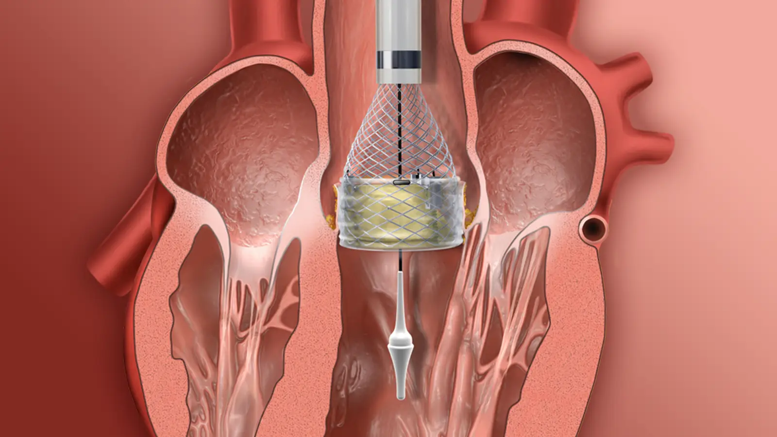 TMVR TTVR transcatheter mitral and tricuspid valve replacement
