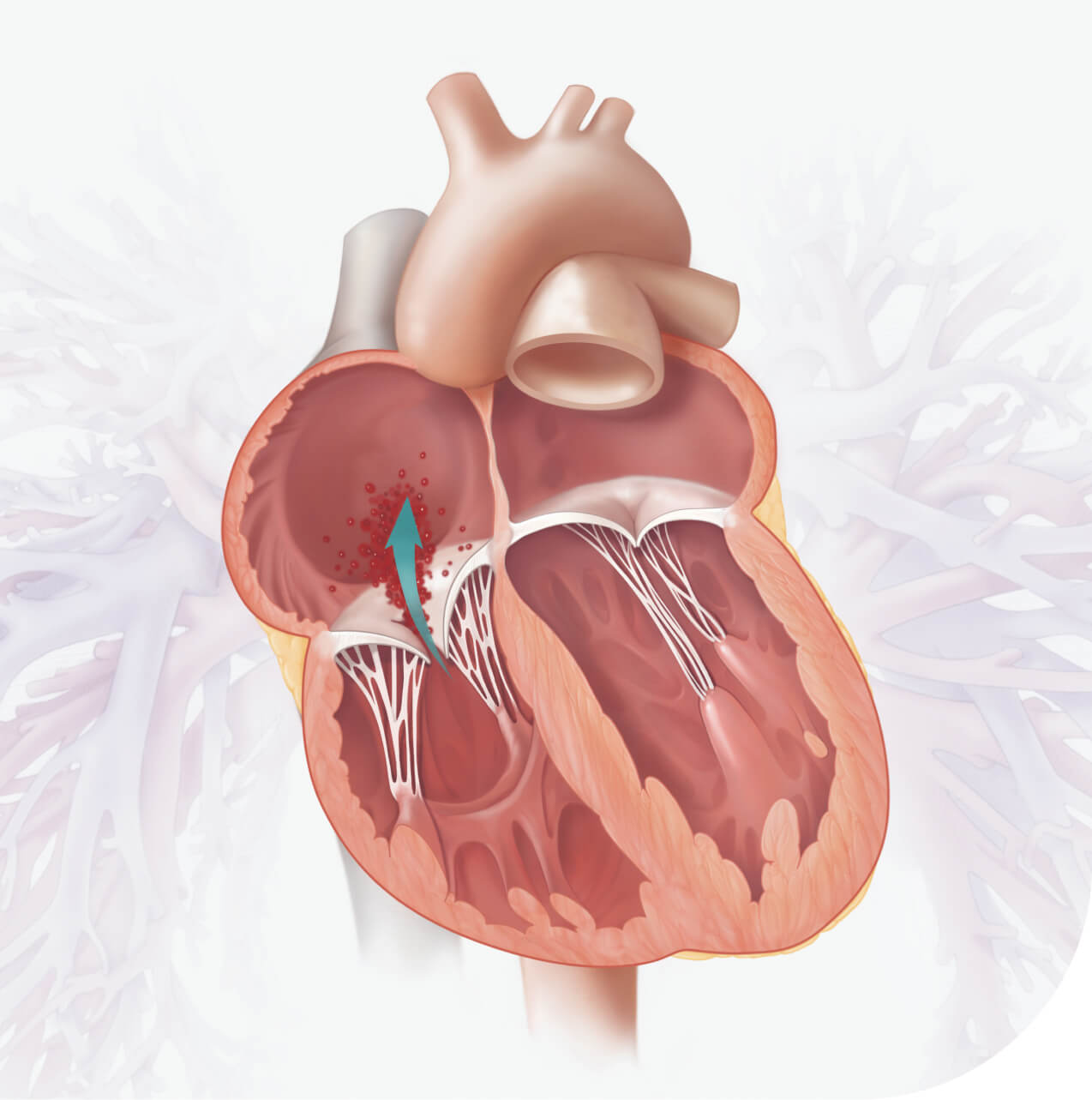 Tricuspid regurgitation right sided valve leak treatment